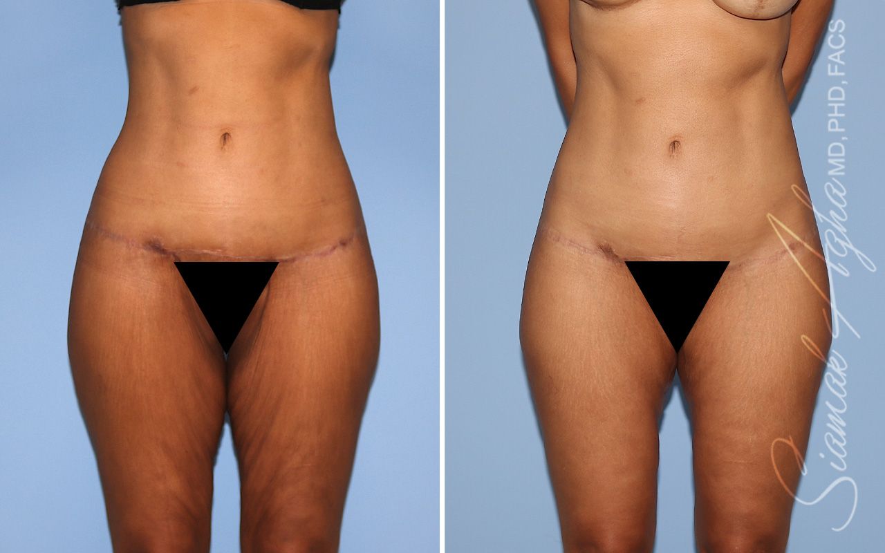 Vertical Thigh Lift Before & After
