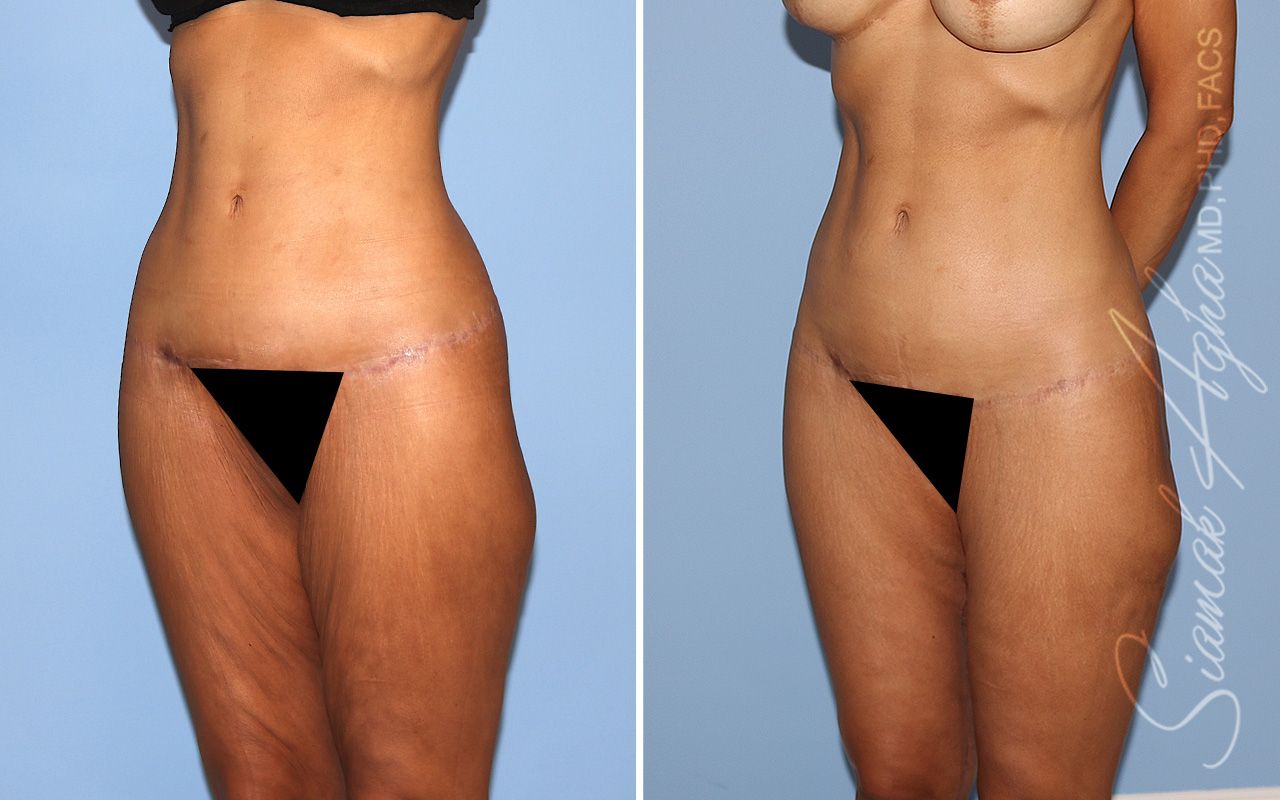 Vertical Thigh Lift Before & After