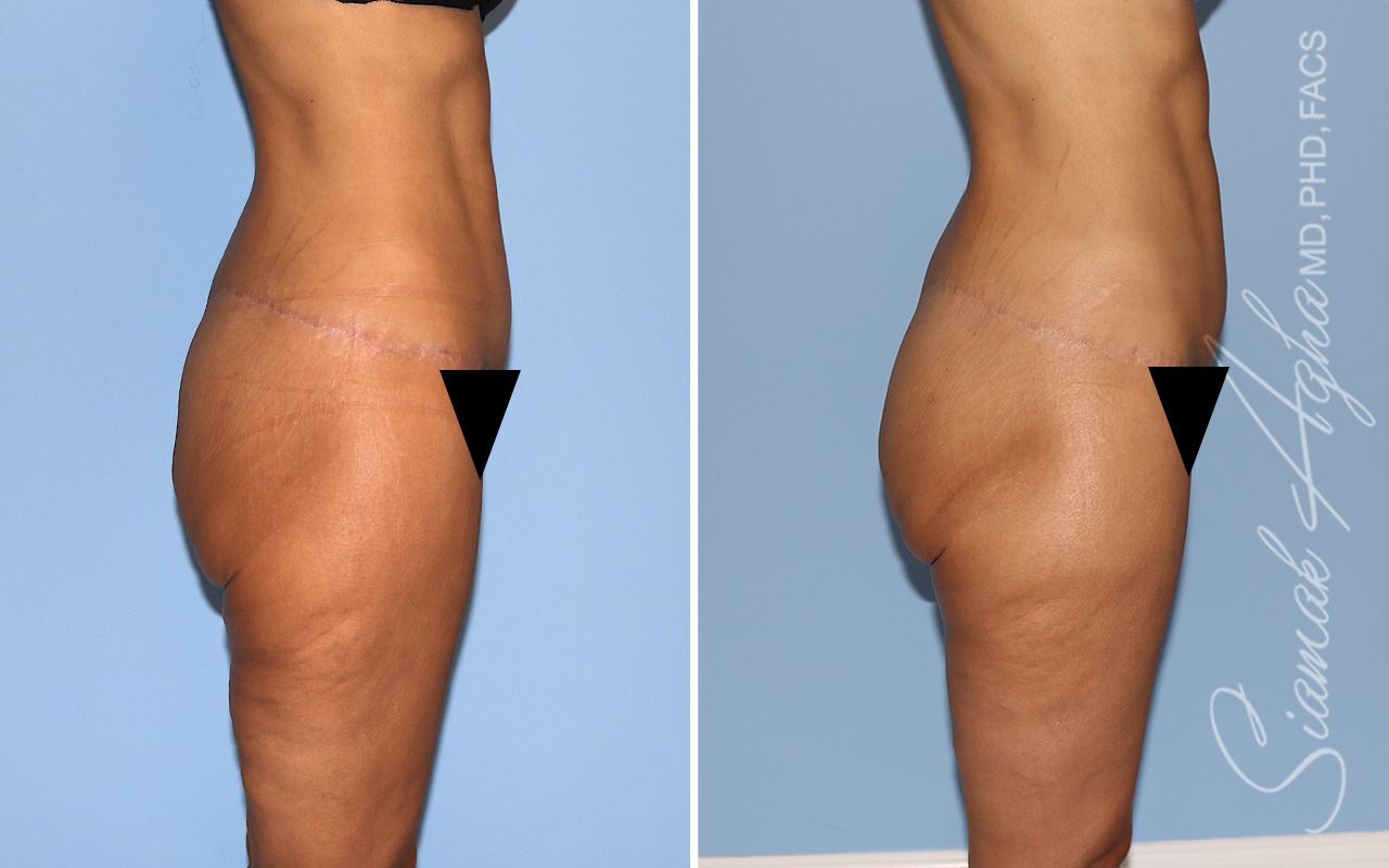 Vertical Thigh Lift Before & After