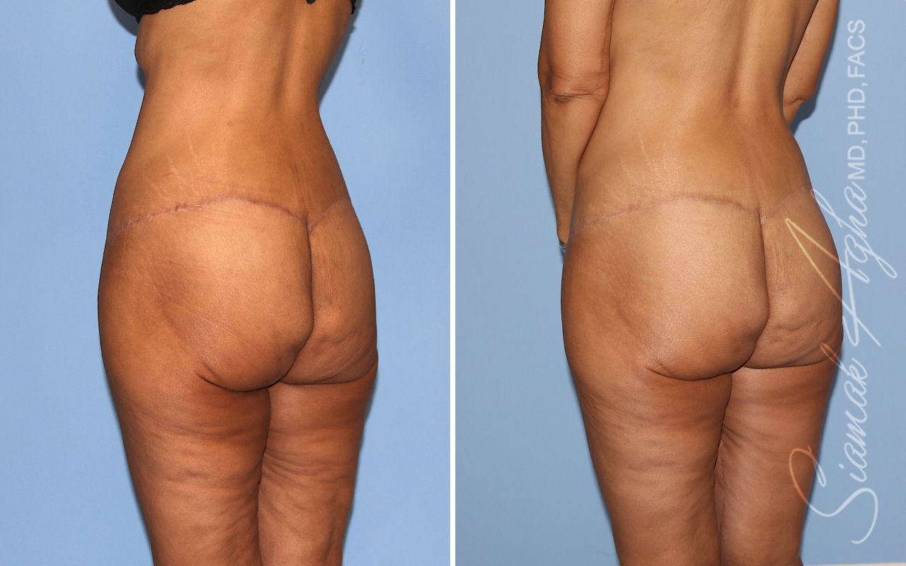 Vertical Thigh Lift Before & After