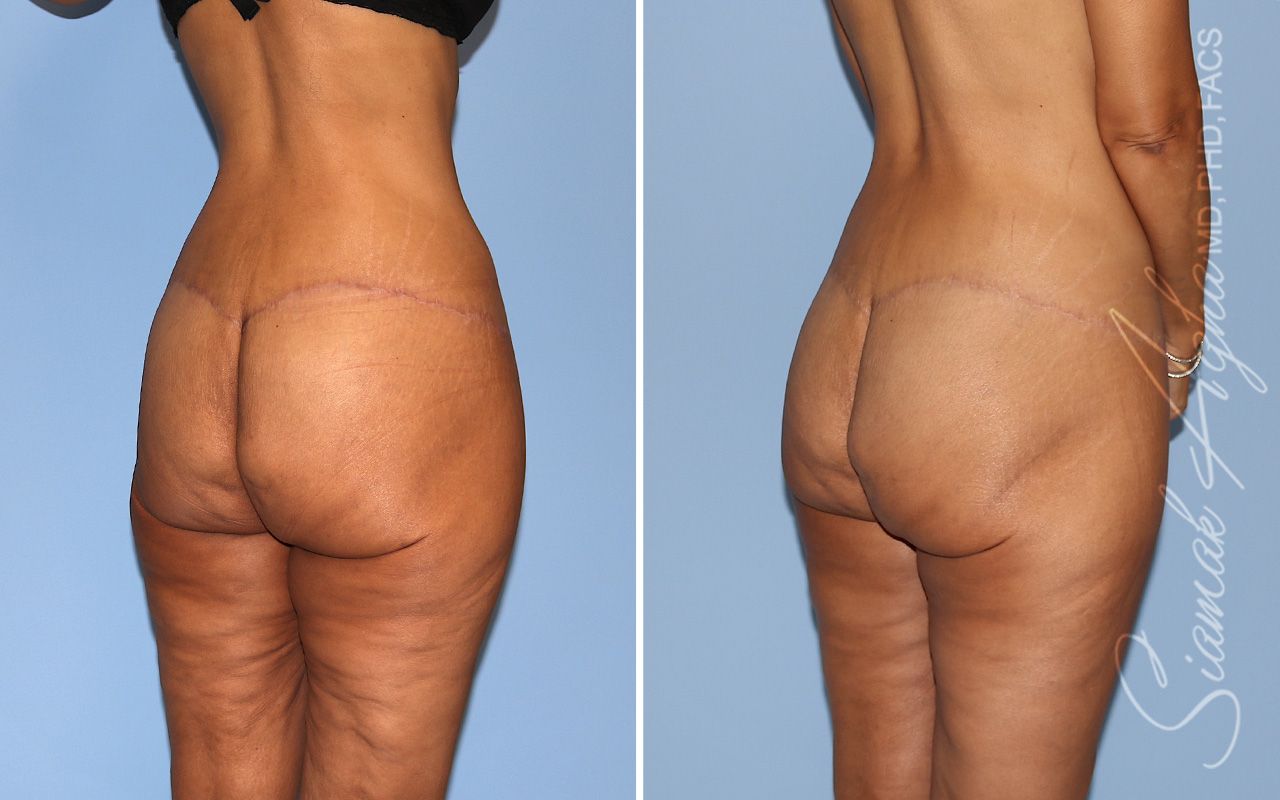 Vertical Thigh Lift Before & After
