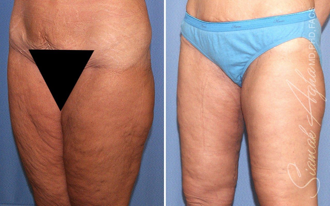 Vertical Thigh Lift Before & After