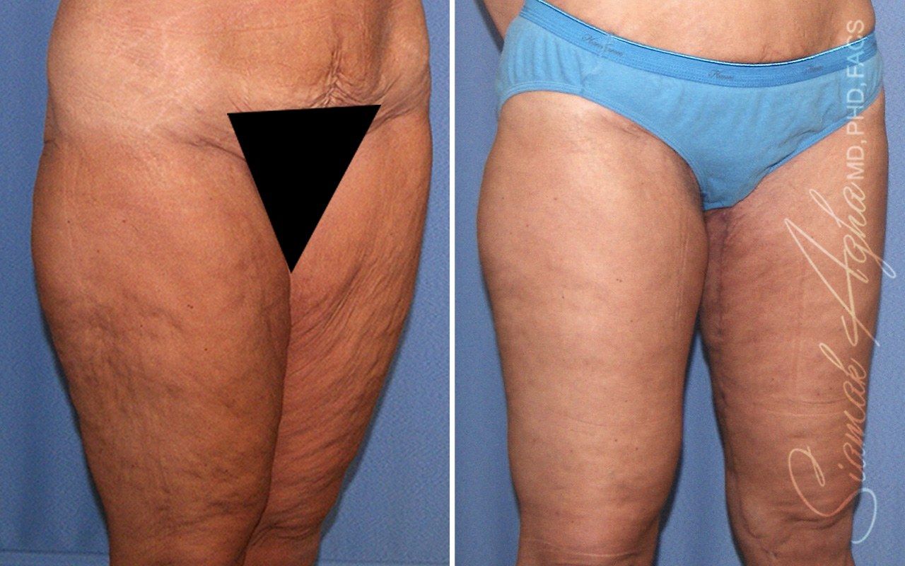 Vertical Thigh Lift Before & After