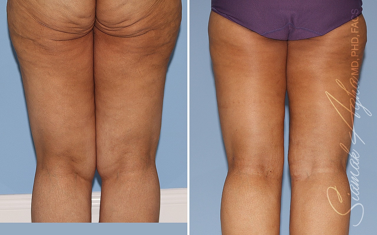 Vertical Thighplasty Before & After
