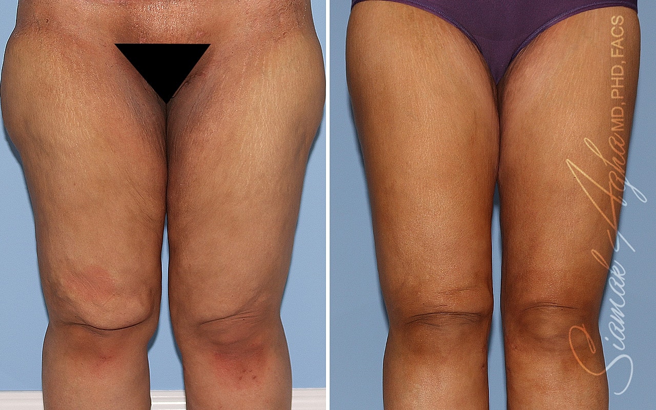 Vertical Thighplasty Before & After