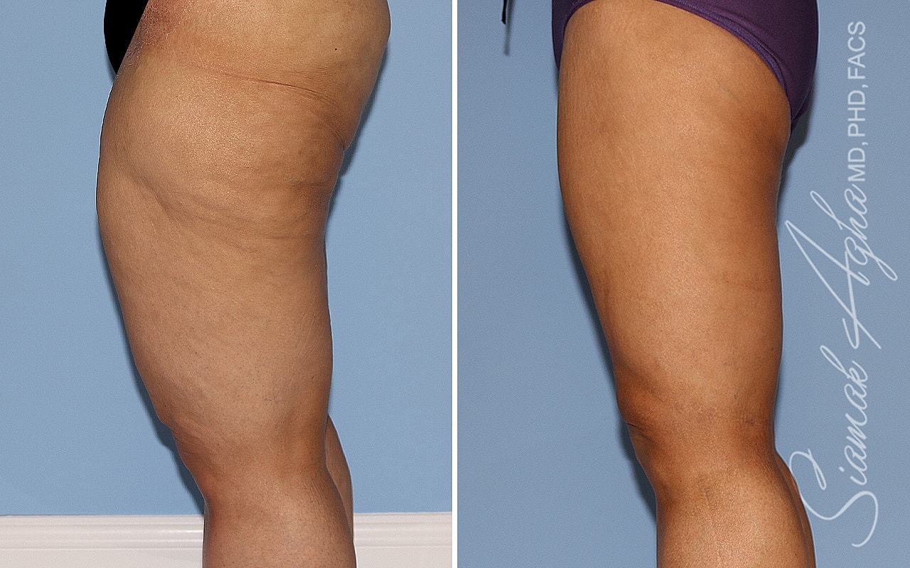 Vertical Thighplasty Before & After