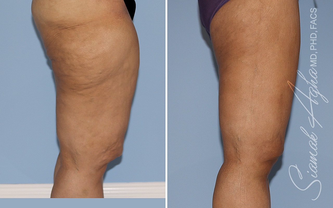 Vertical Thighplasty Before & After