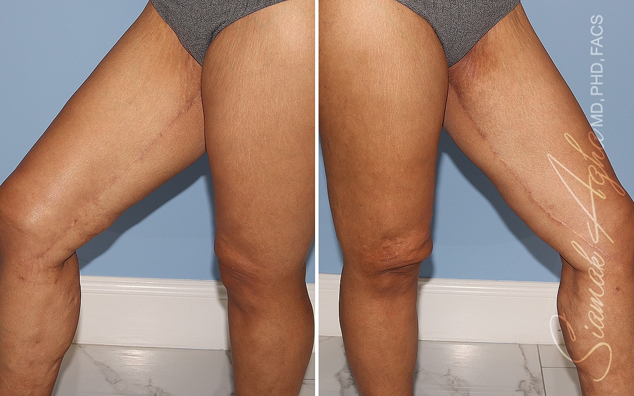 Vertical Thighplasty Before & After