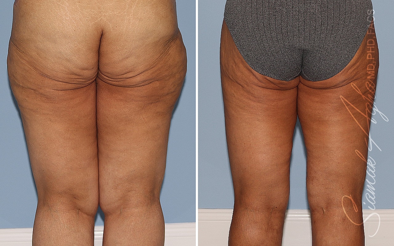 Vertical Thighplasty Before & After