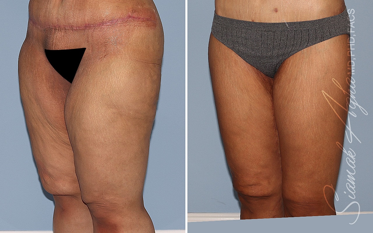 Vertical Thighplasty Before & After