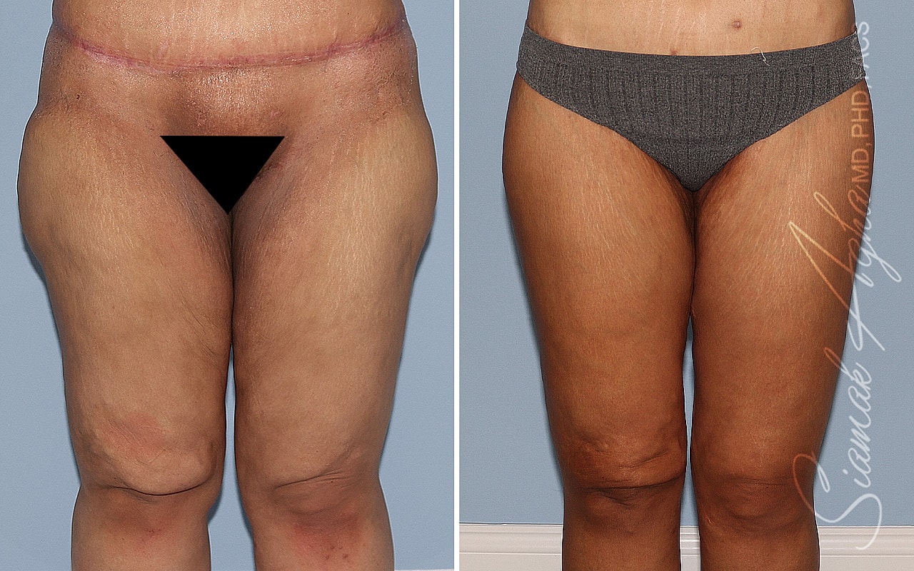 Vertical Thighplasty Before & After