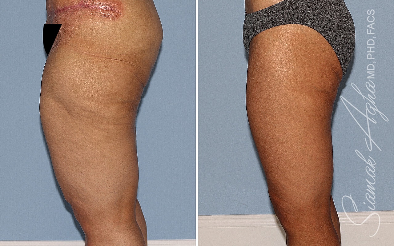 Vertical Thighplasty Before & After