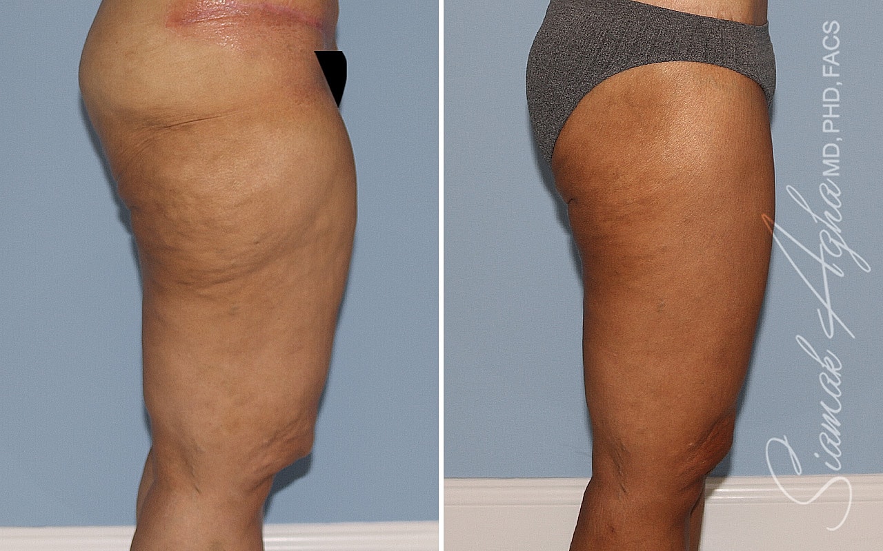 Vertical Thighplasty Before & After