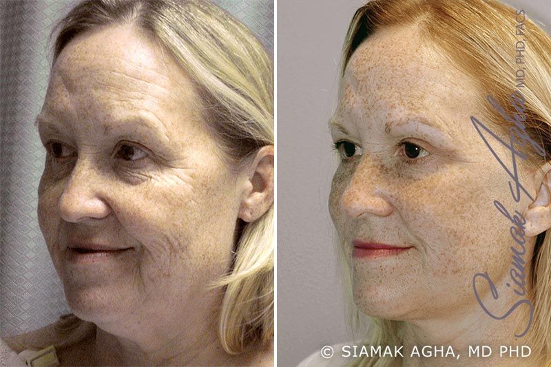 Facelift Before & After