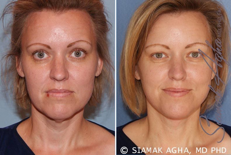 Facelift Before & After