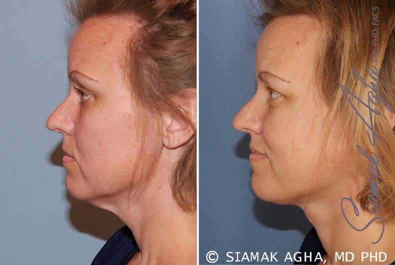 Facelift Before & After