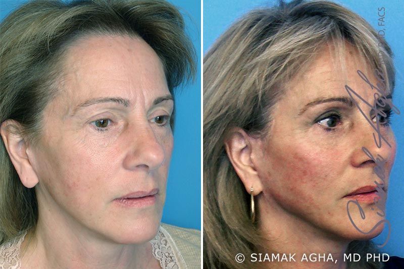 Facelift Before & After