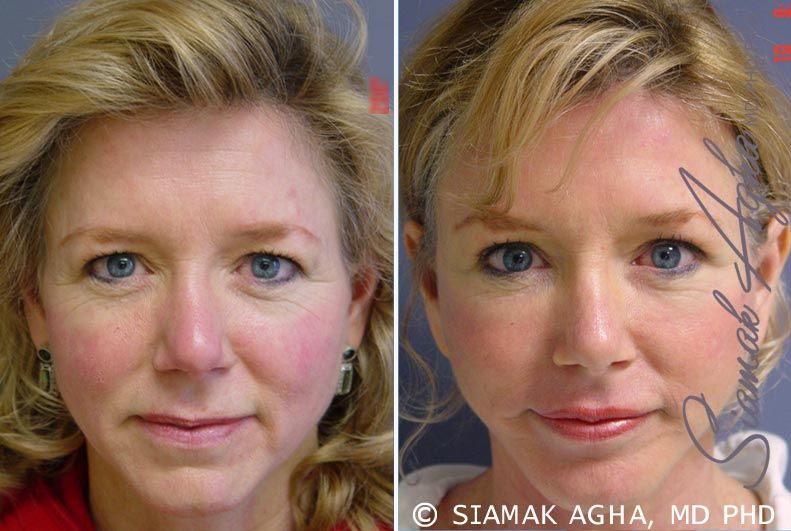 Facelift Before & After