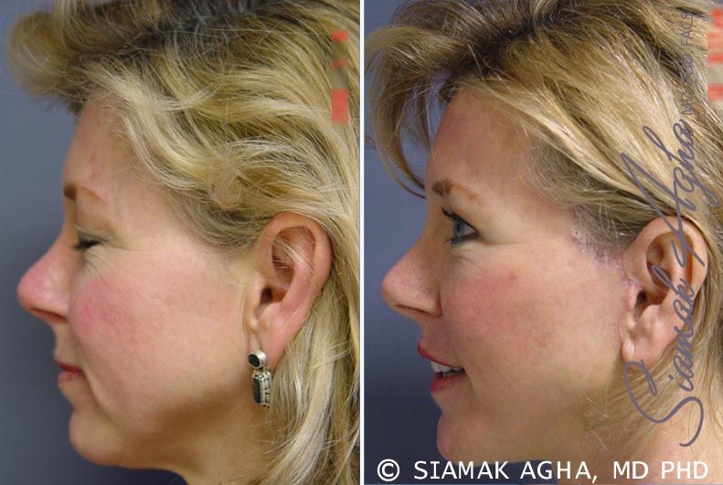 Facelift Before & After