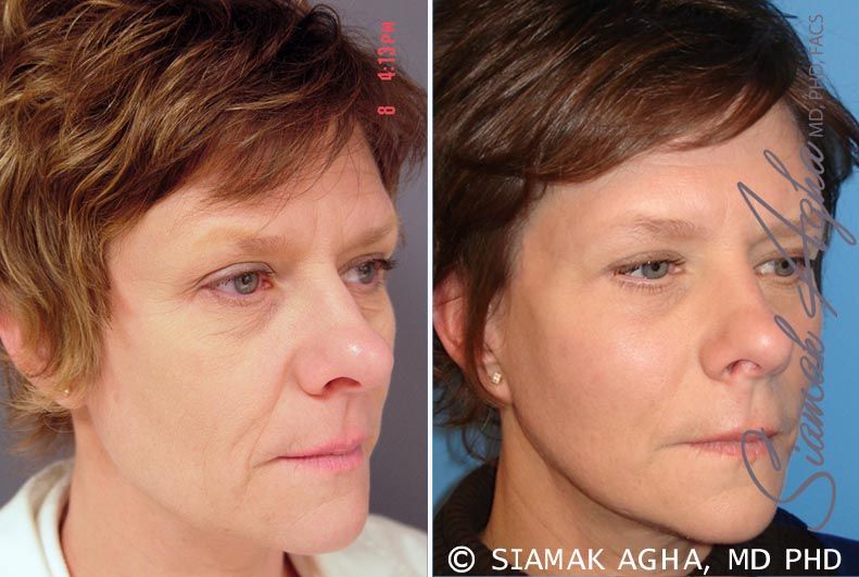 Facelift Before & After