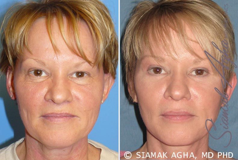 Facelift Before & After