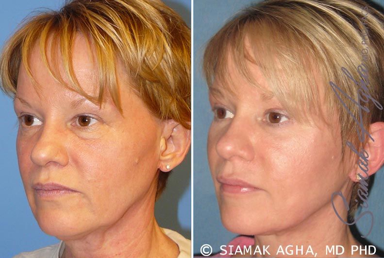 Facelift Before & After
