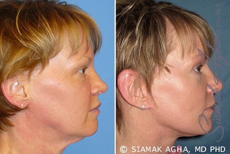 Facelift Before & After
