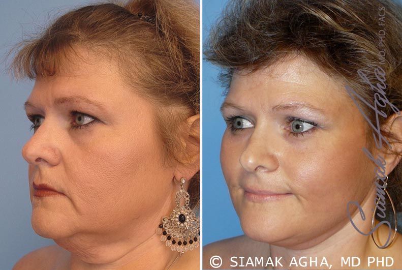 Facelift Before & After