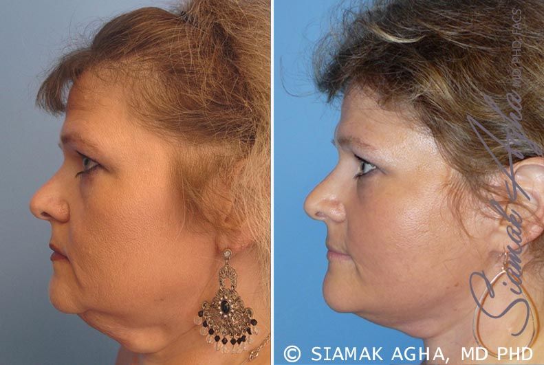 Facelift Before & After