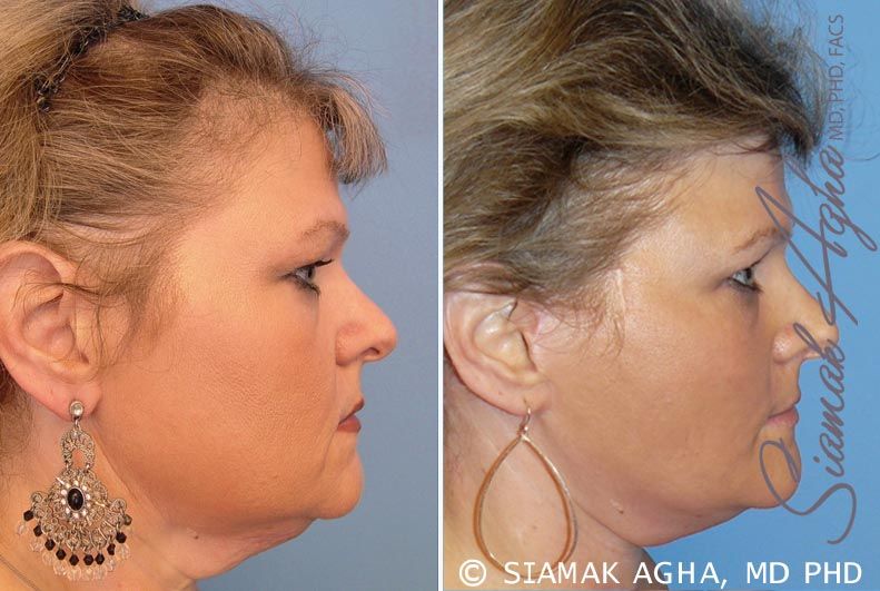 Facelift Before & After
