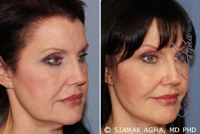 Facelift Before & After