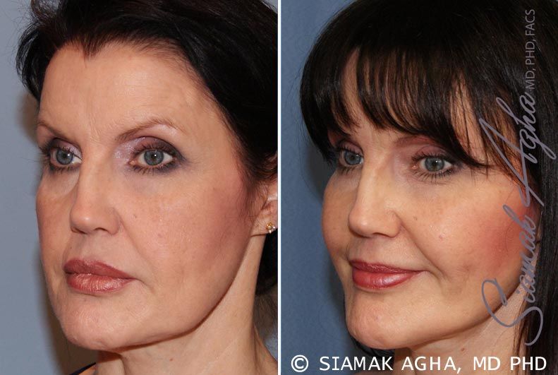 Facelift Before & After