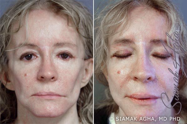 Facelift Before & After