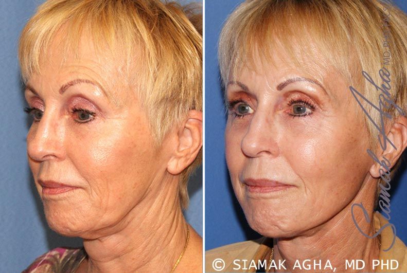 Facelift Before & After