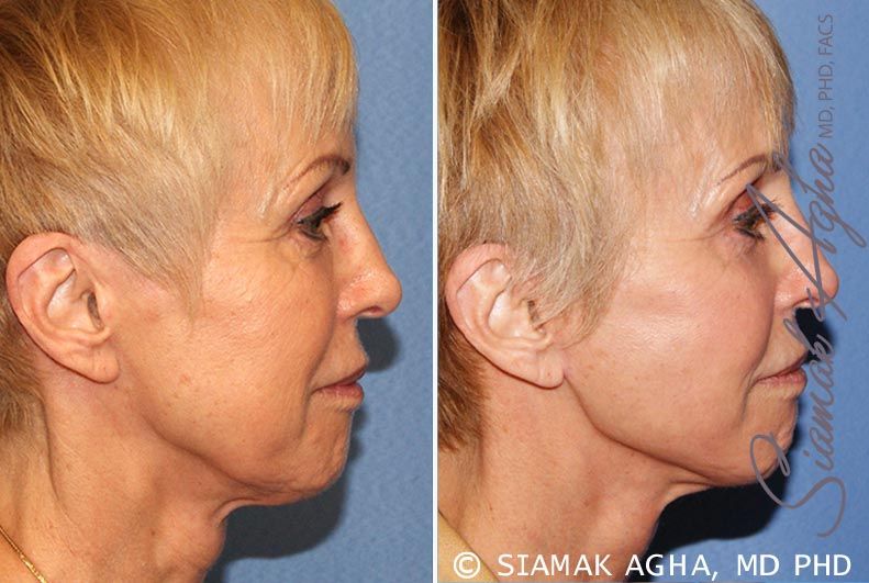 Facelift Before & After