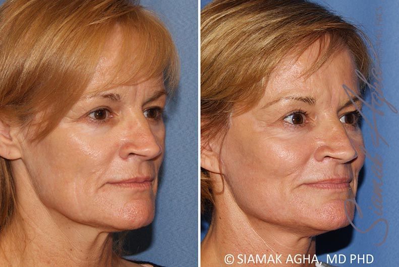 Facelift Before & After