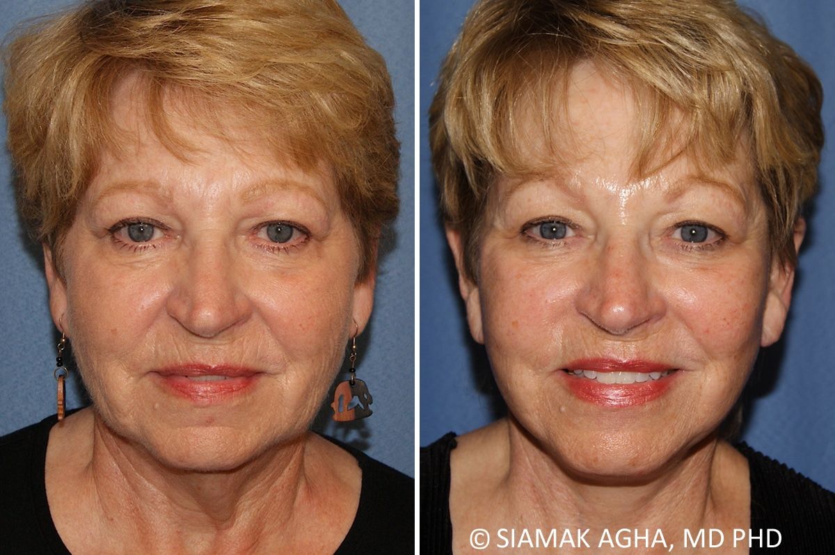 Facelift Before & After