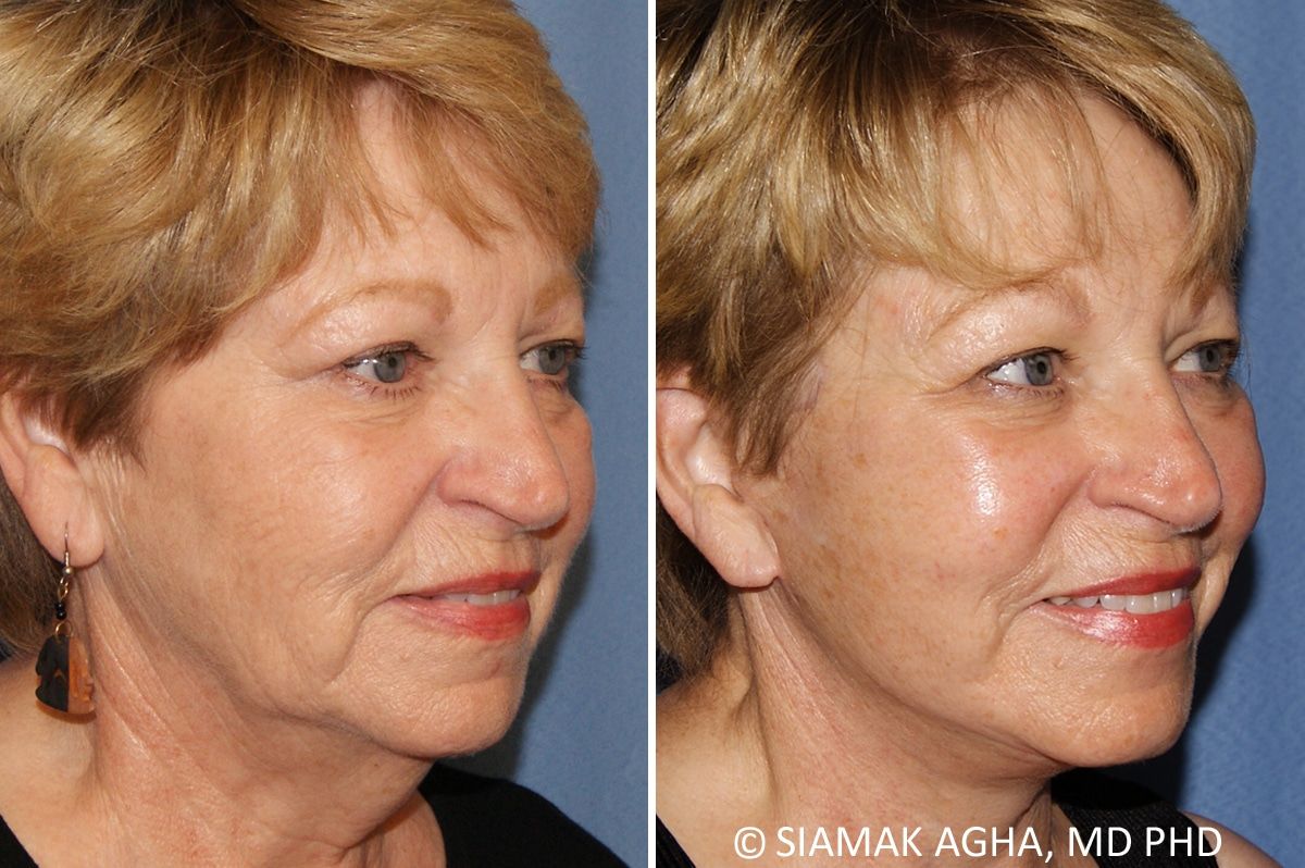 Facelift Before & After