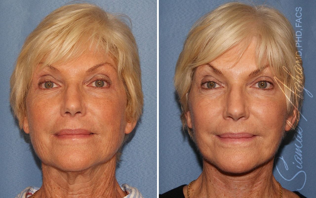 Facelift Before & After