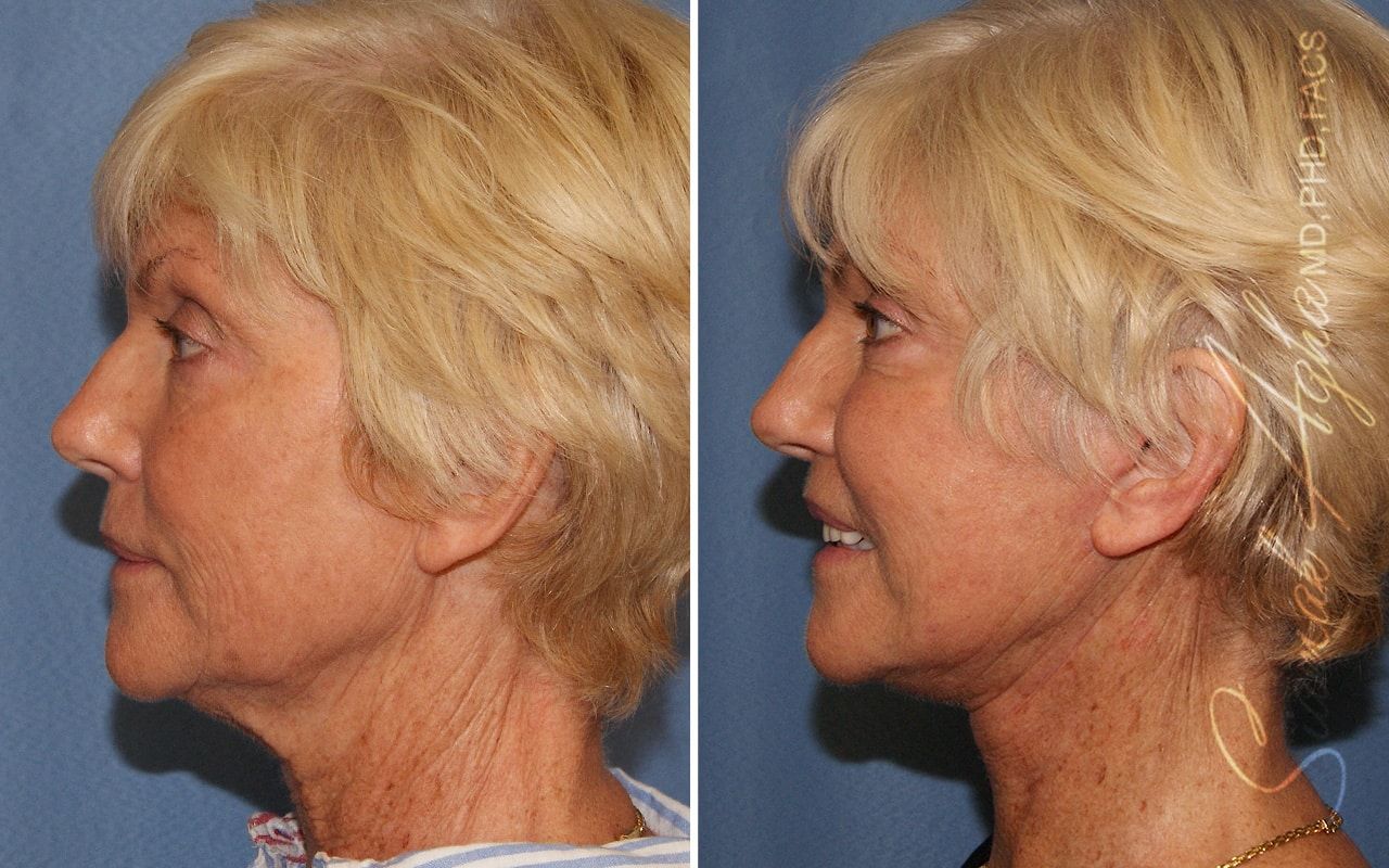 Facelift Before & After