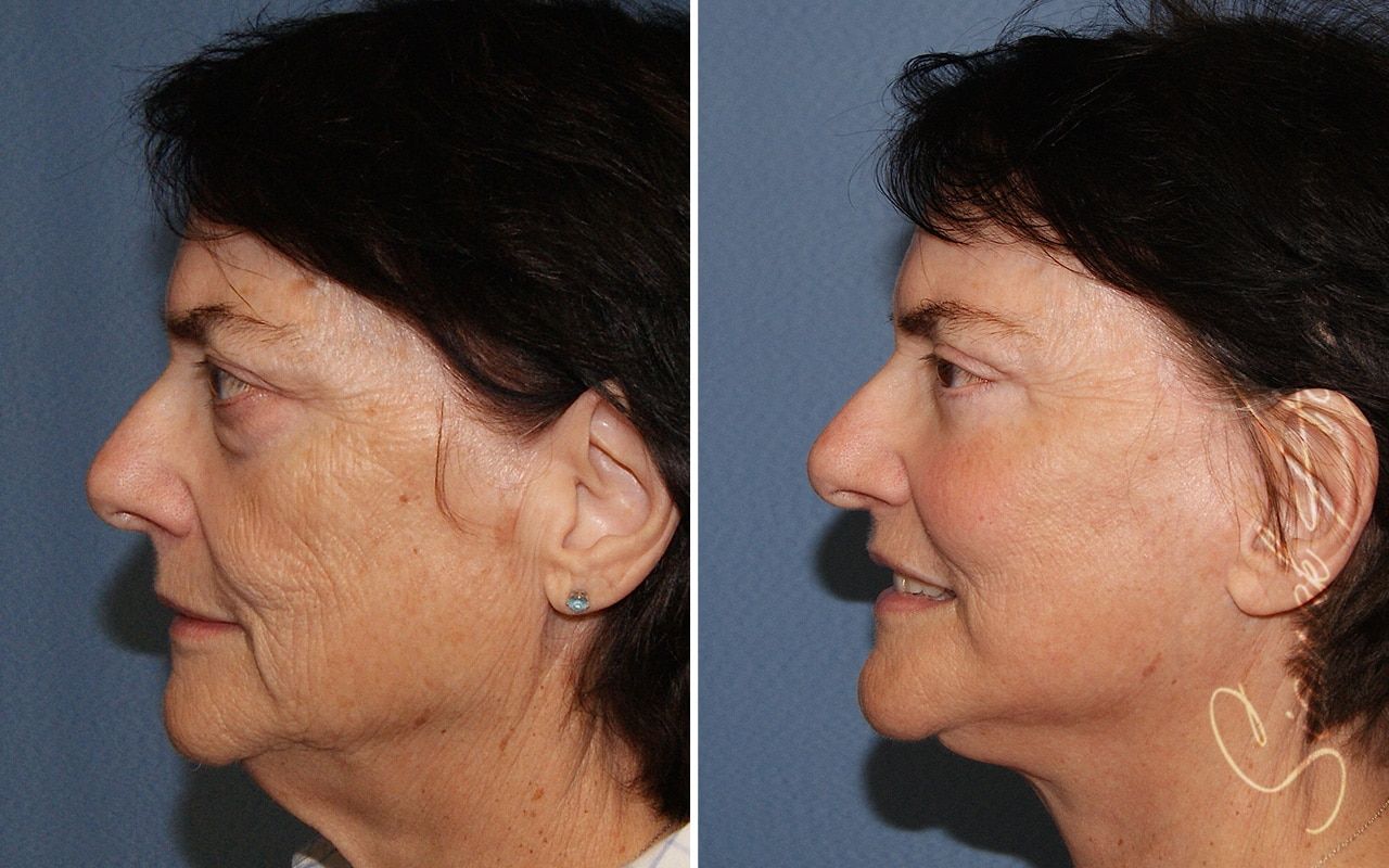 Facelift Before & After
