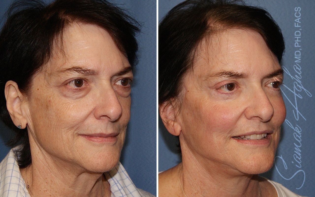 Facelift Before & After