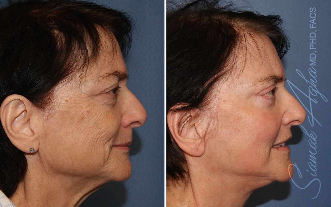 Facelift Before & After