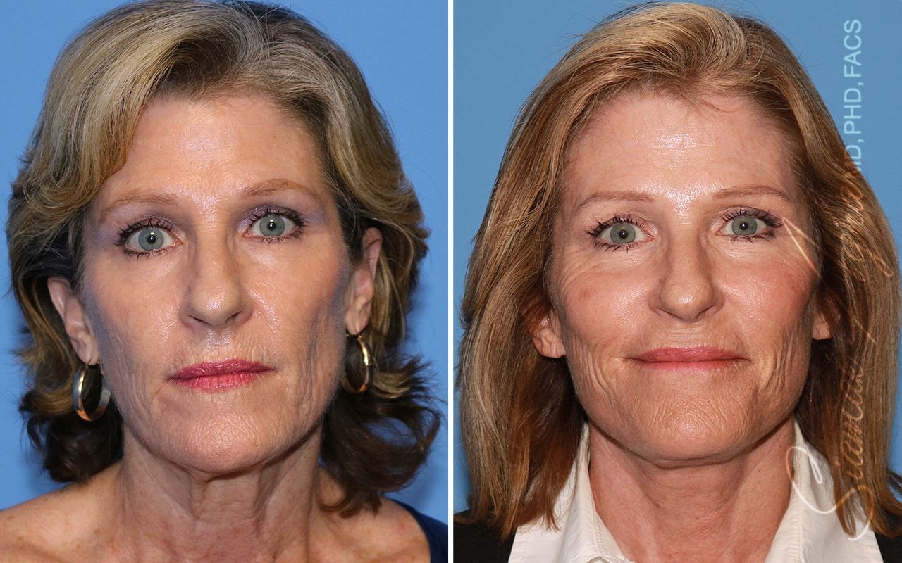 Facelift Before & After