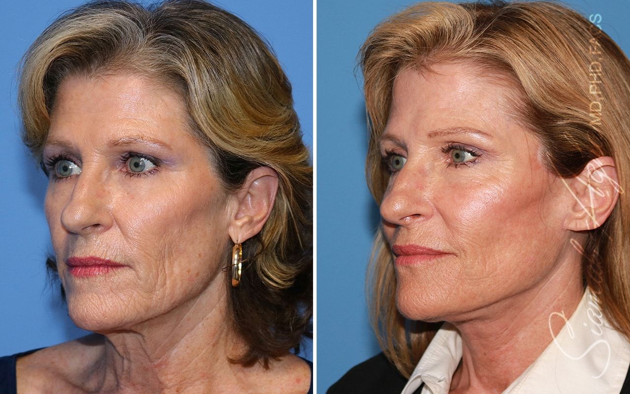 Facelift Before & After