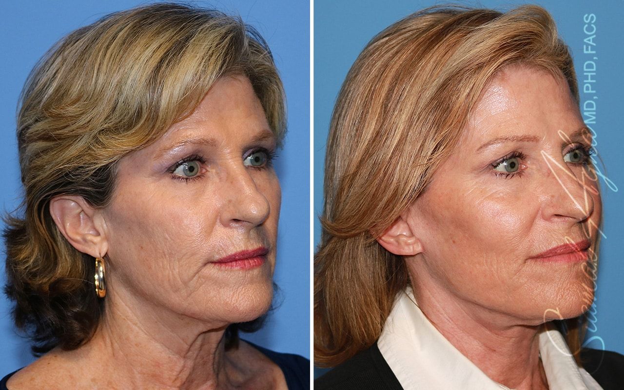 Facelift Before & After
