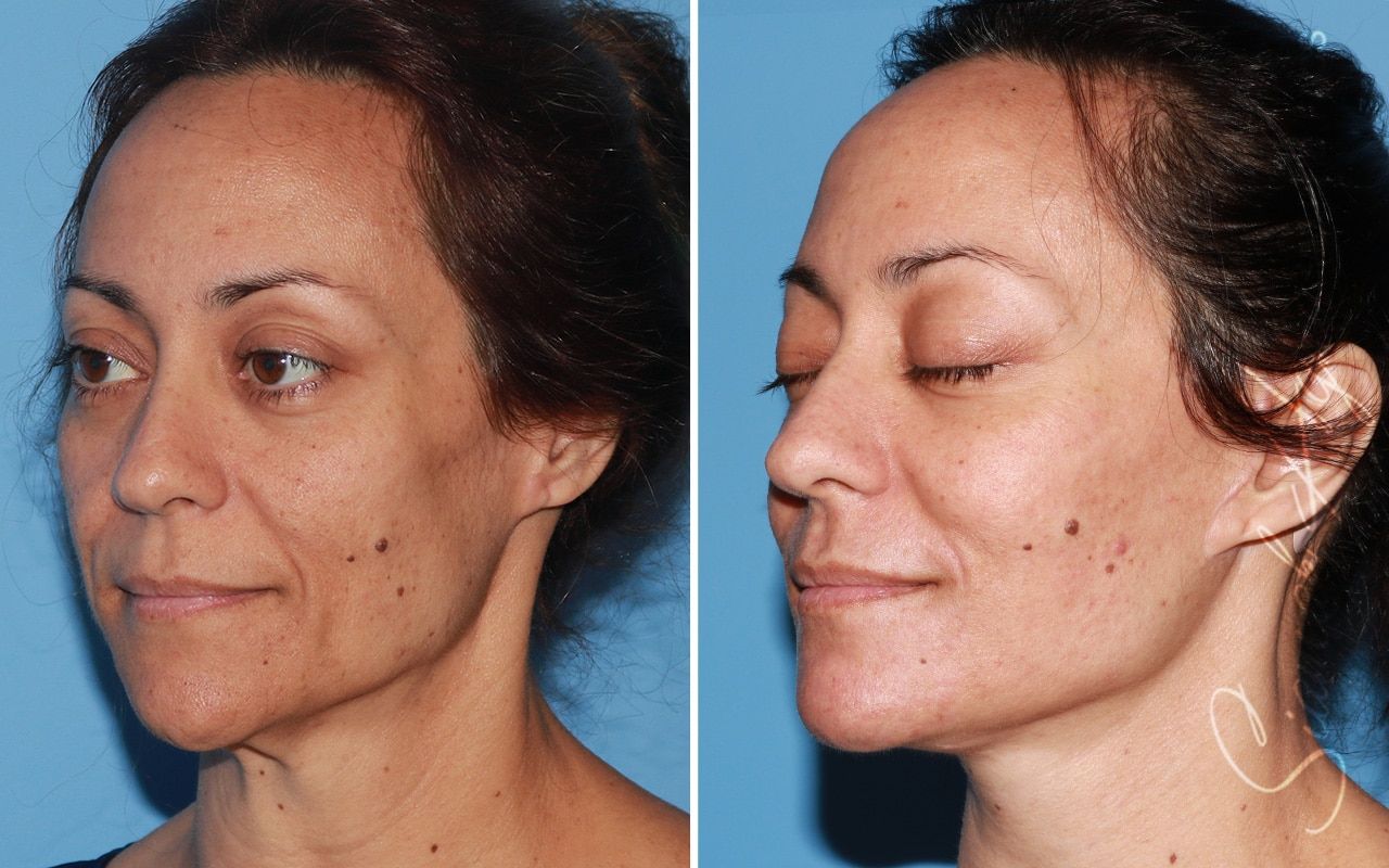 Facelift Before & After