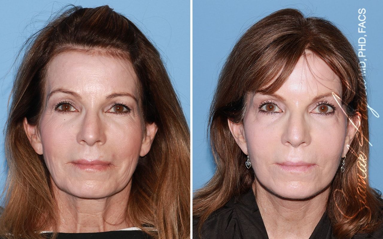 Facelift Before & After