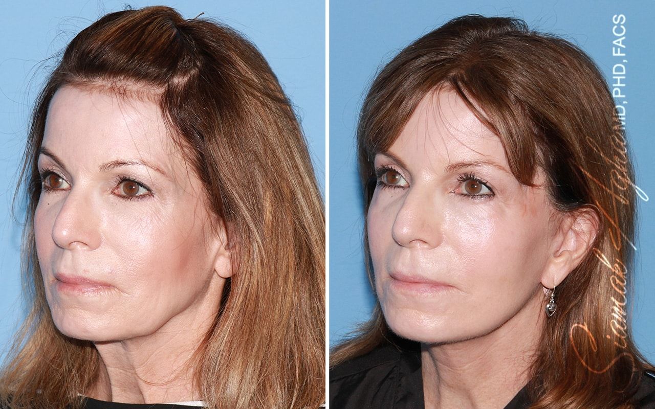 Facelift Before & After