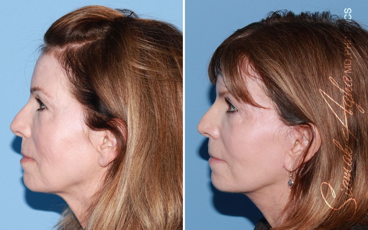 Facelift Before & After